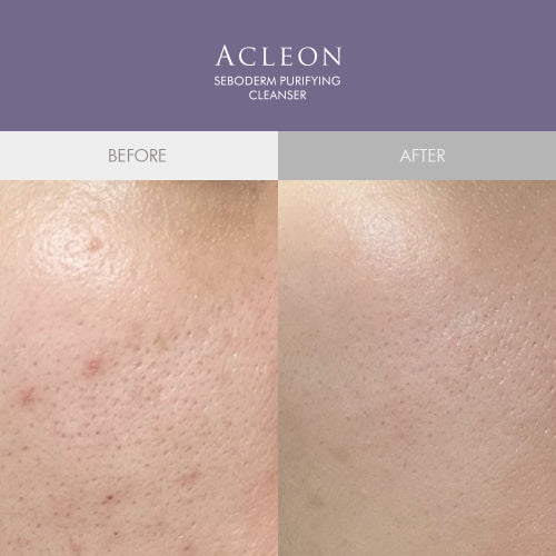 ACLEON ACLEON Blackhead Sebum Softener Cleanser Set