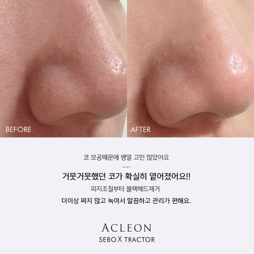 ACLEON ACLEON Blackhead Sebum Softener Cleanser Set