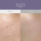 ACLEON ACLEON Anasys Mild Alkaline Cleansing Foam